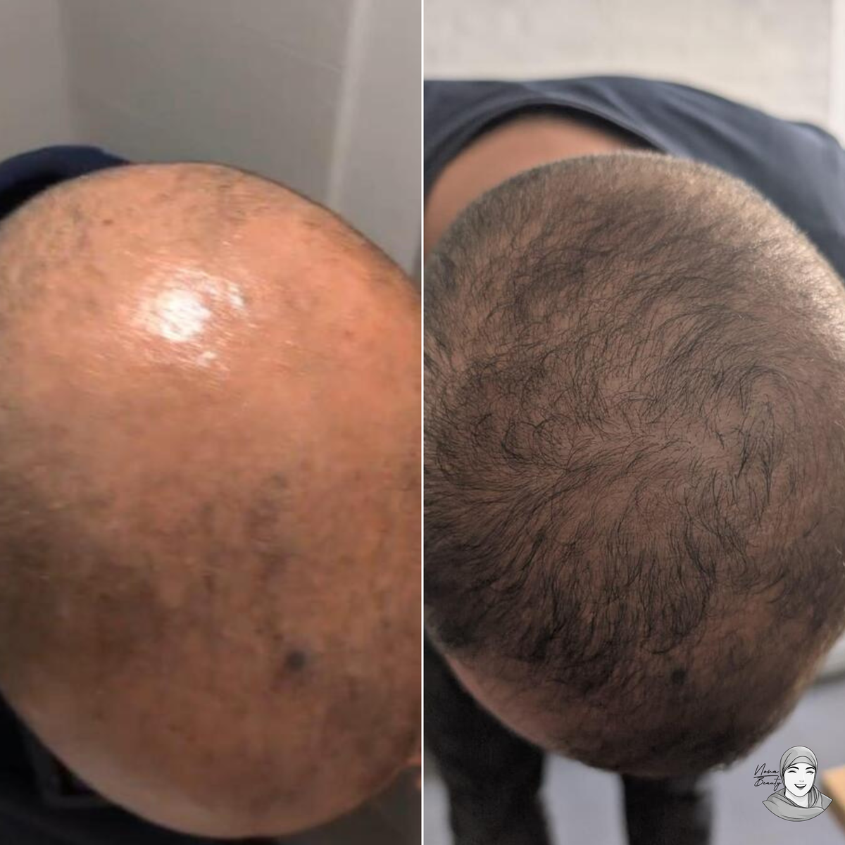 Lotion Pousse Extrême & Anti Chute de Cheveux - 100 ml - Sans Rinçage - Homme