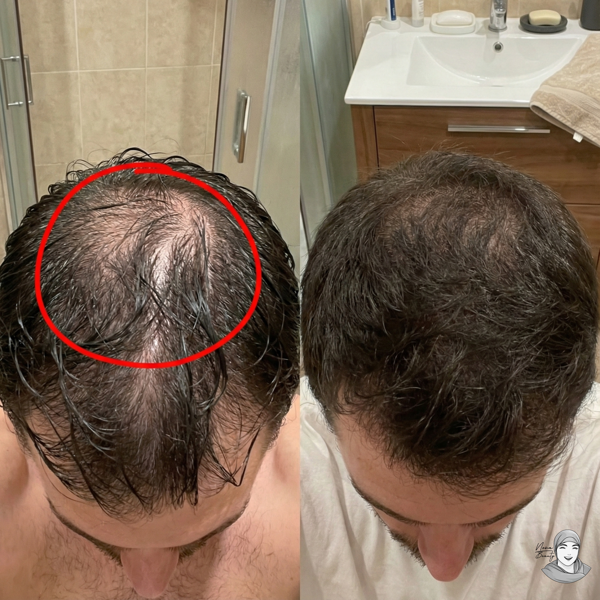 Lotion Pousse Extrême & Anti Chute de Cheveux - 100 ml - Sans Rinçage - Homme